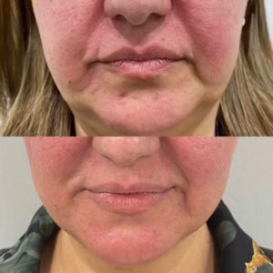 Morpheus8 for skin tightening treatment