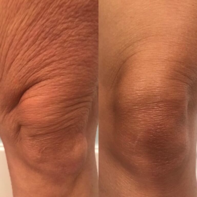 Morpheus8 knee skin tightening