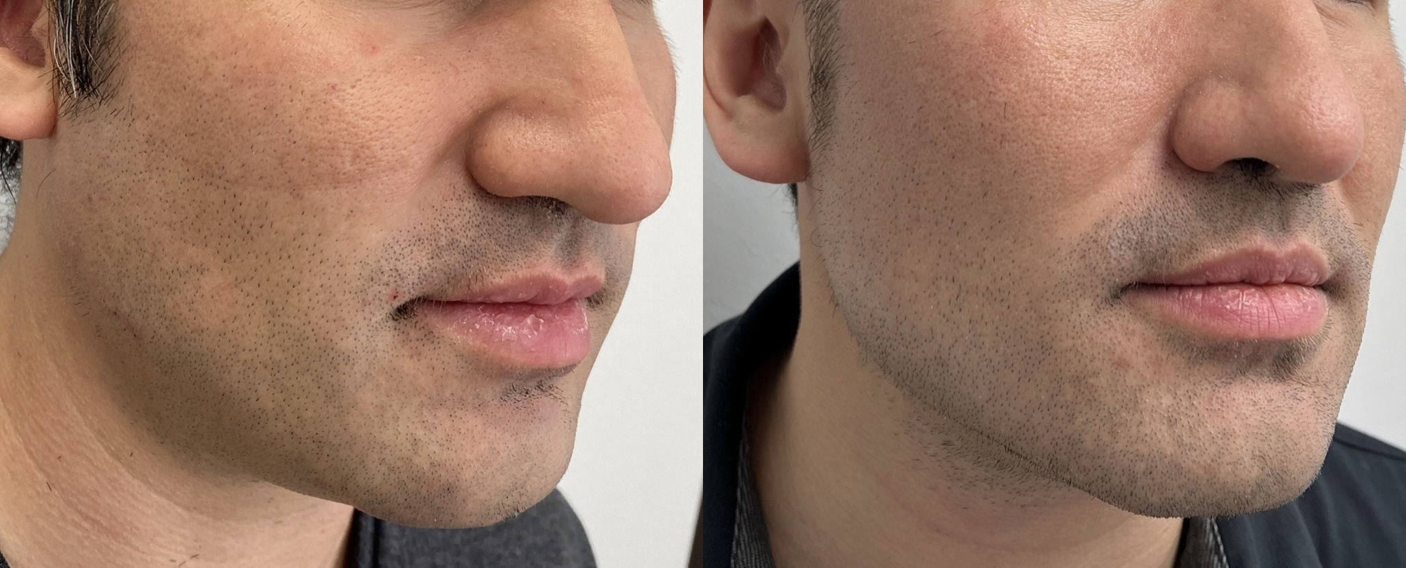 Morpheus8 treatment results