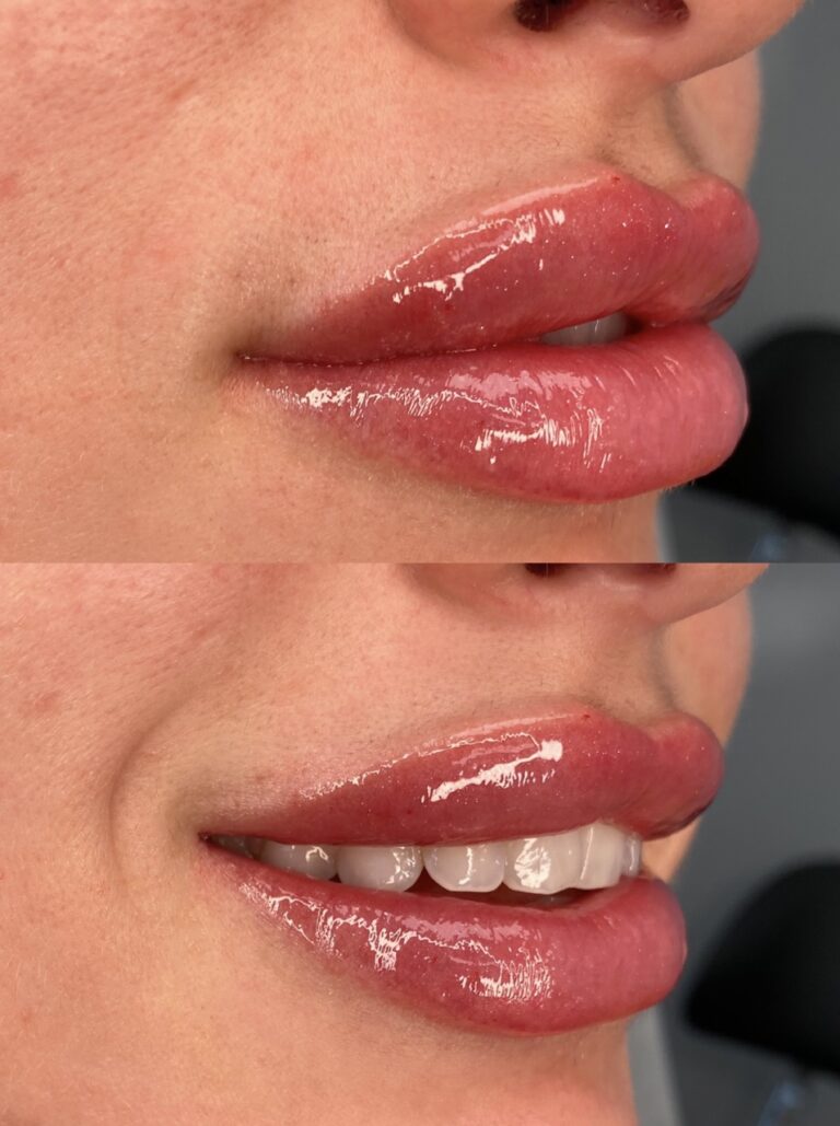 Restylane Injectable filler example
