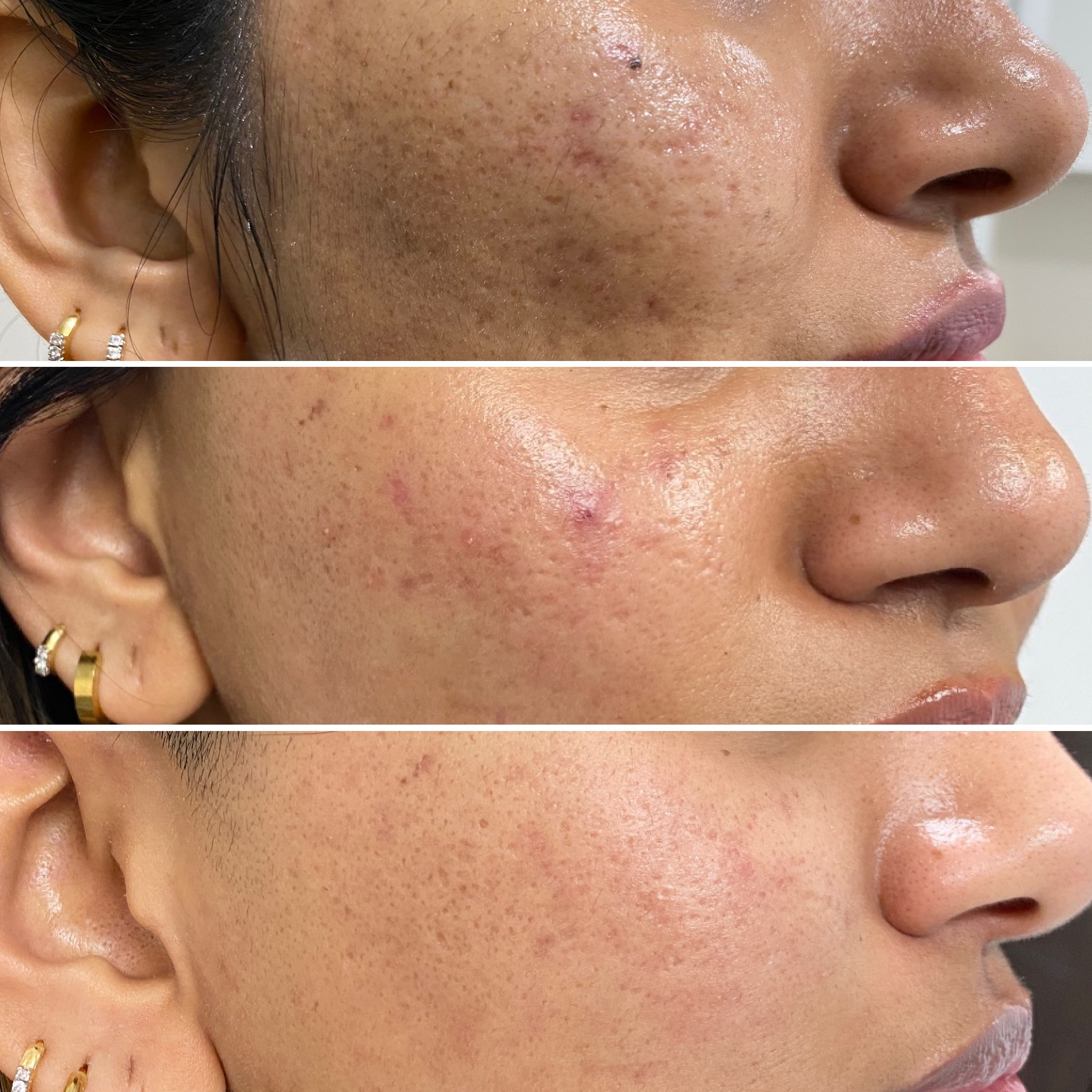 Acne Scar removal with morpheus8