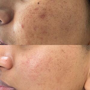 Before and after for acne scars with Morpheus8