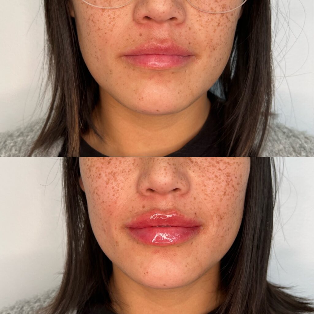 Lip fillers near me