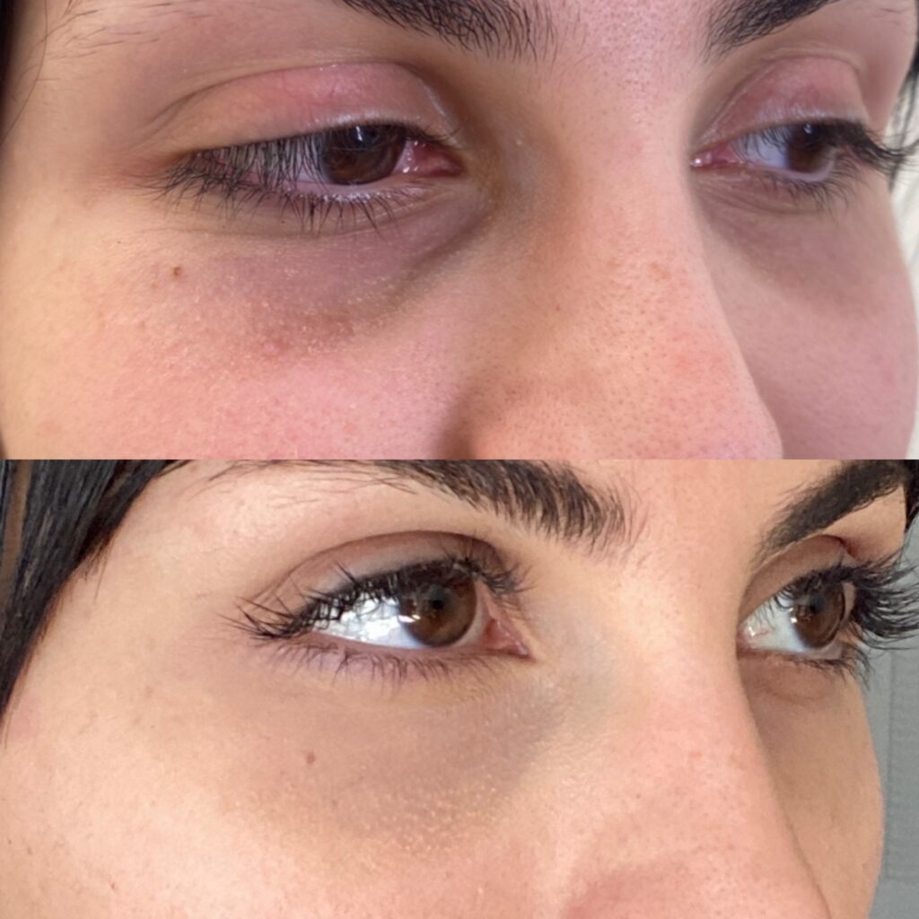 morpheus8 inmode prime eyes