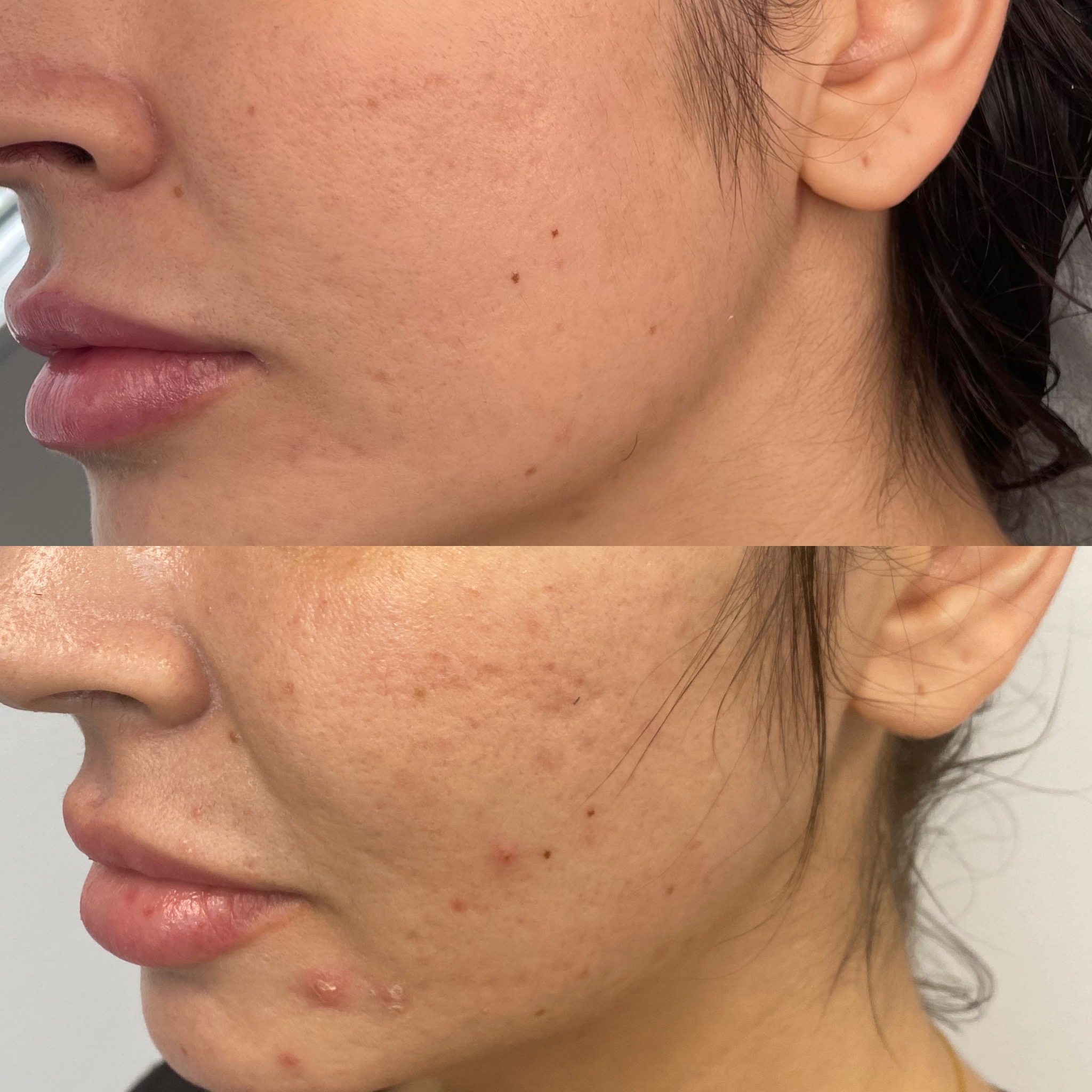 morpheus8-before-and-after-of-resurfacing