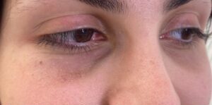 Morpheus 8 Prime eyes example for skin care 300x300 1