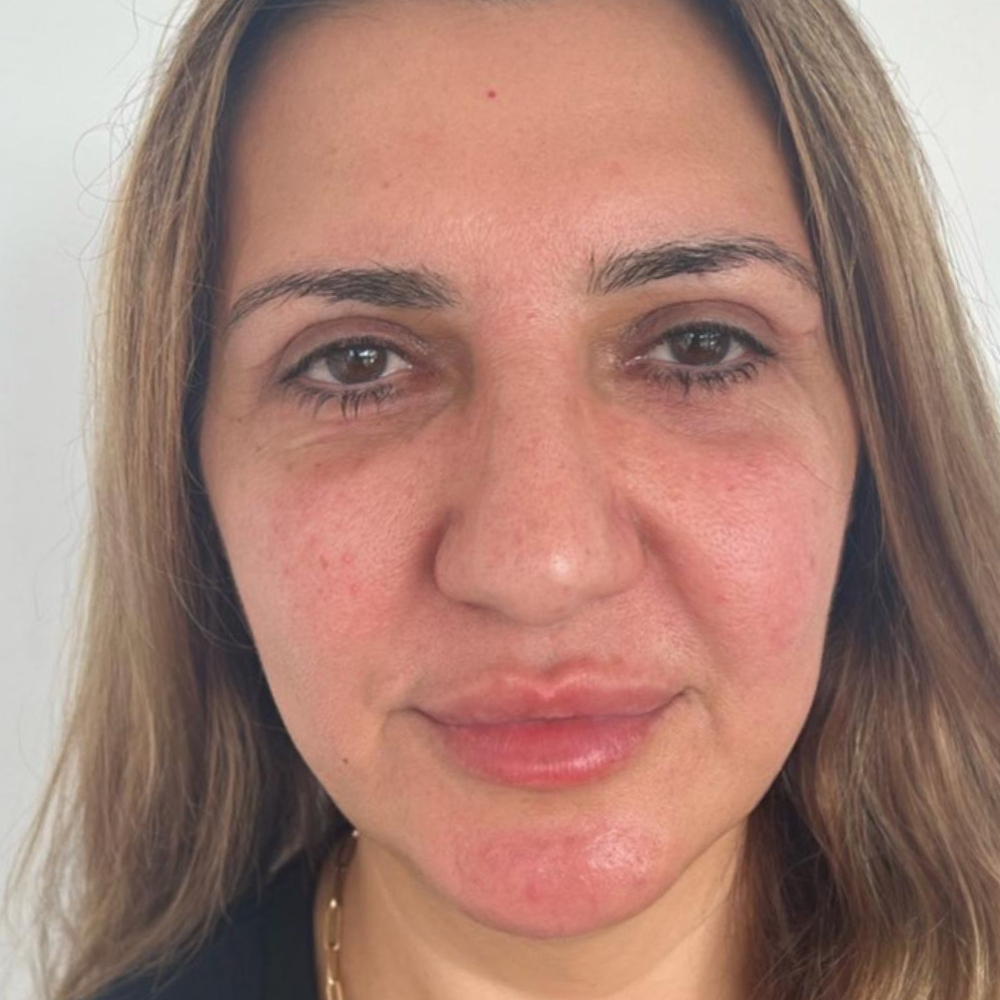 Morpheus8 for face after