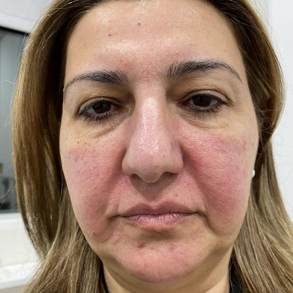 Morpheus8 for face before