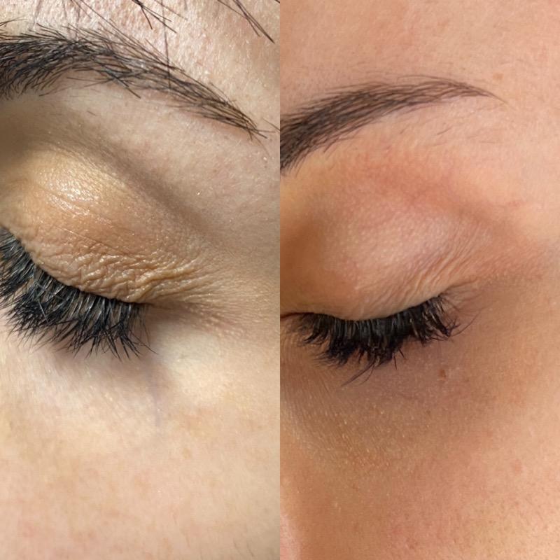 Morpheus8 Non-Surgical Eyelid Tightening (Upper Bleph)
