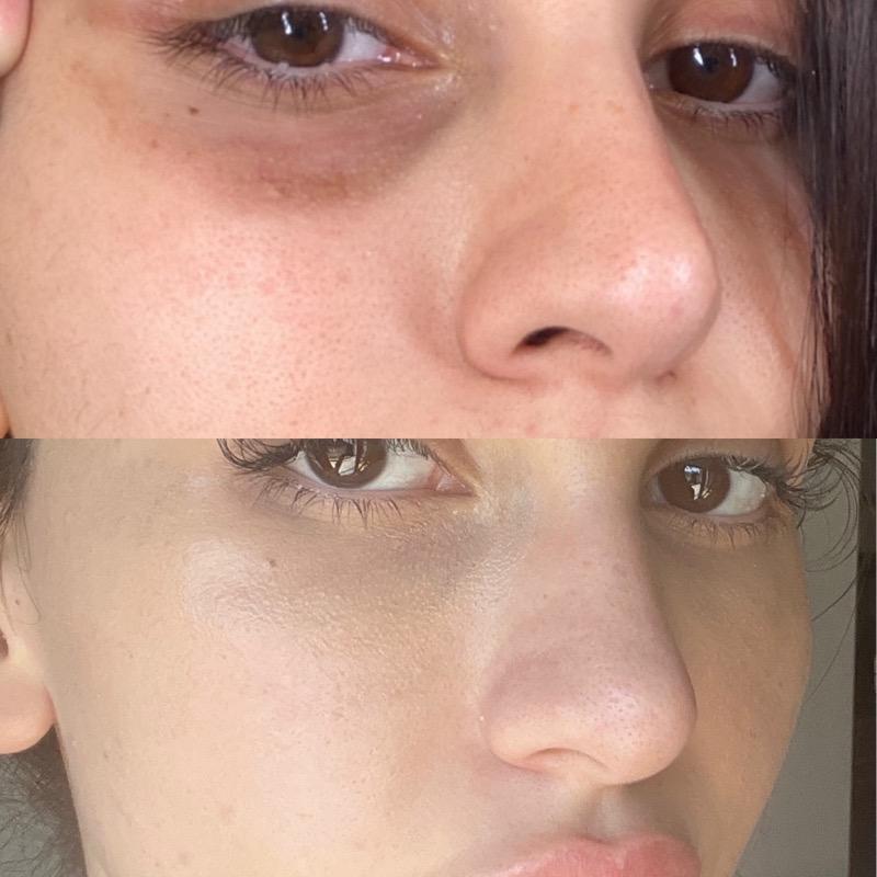 Morpheus8 and PRP Treatment for Under Eyes and Dark Circles
