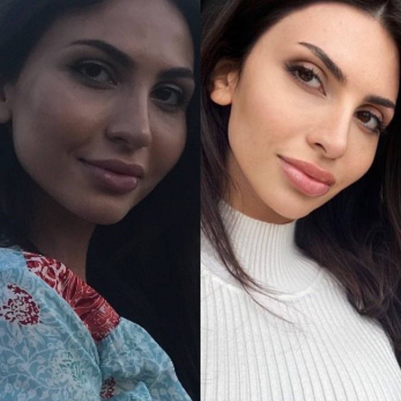 Morpheus8 Facial Slimming Treatment