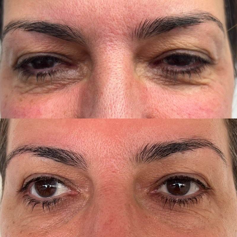 Morpheus8 Prime for Under Eyes and Upper Eyelids