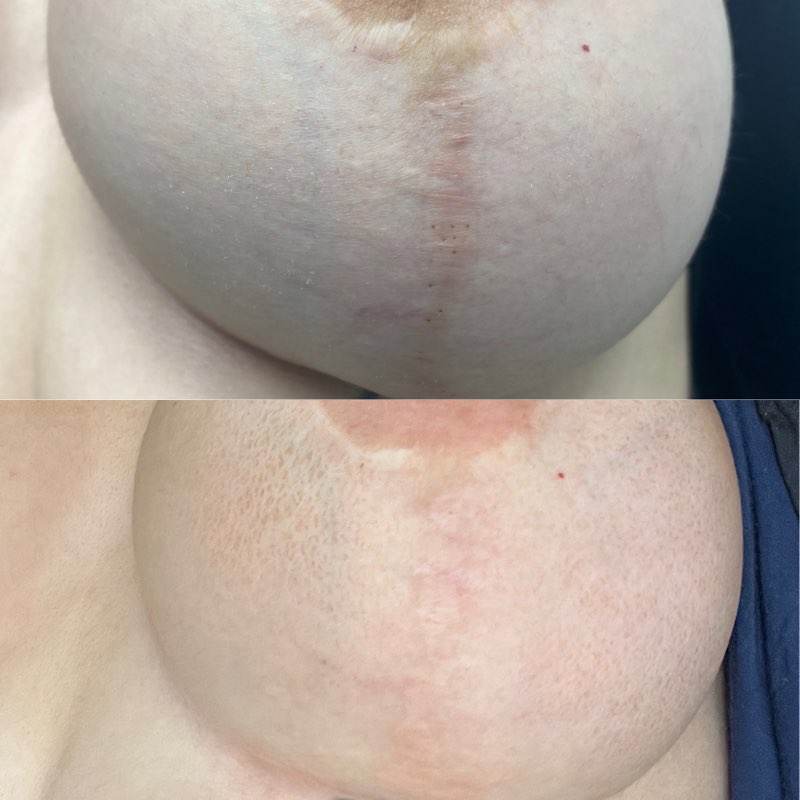 Morpheus8 Post-Surgical Scar Reduction