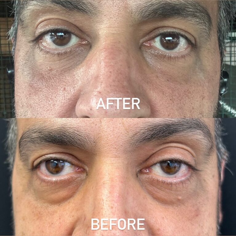 Before and after Image of Prf ez gel - Skinsation LA