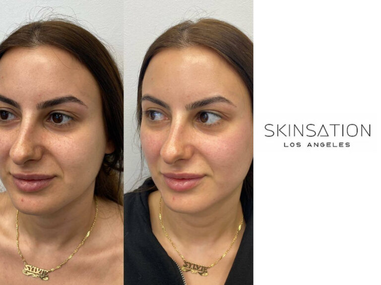 Example of Botox in Los Angeles