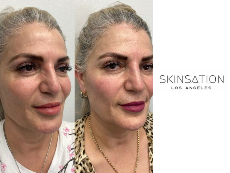 Example of Dermal Filler in Los Angeles
