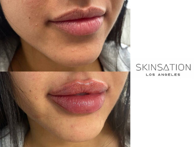 Example of Lip filler in Los Angeles