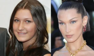 bella hadid before after