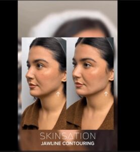 Example of Jawline Contouring in Los Angeles CA - Skinsation LA