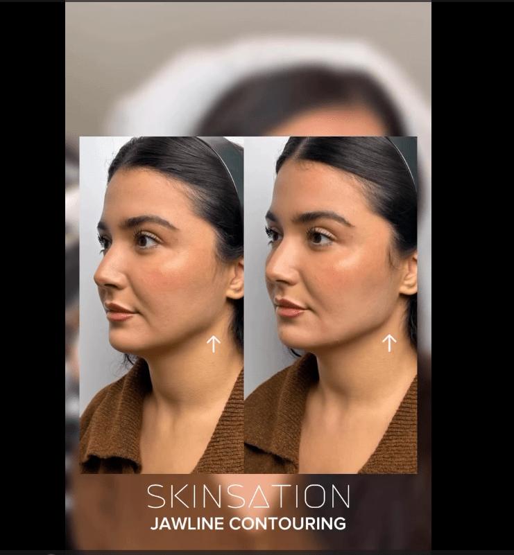 Example of Jawline Contouring in Los Angeles CA - Skinsation LA