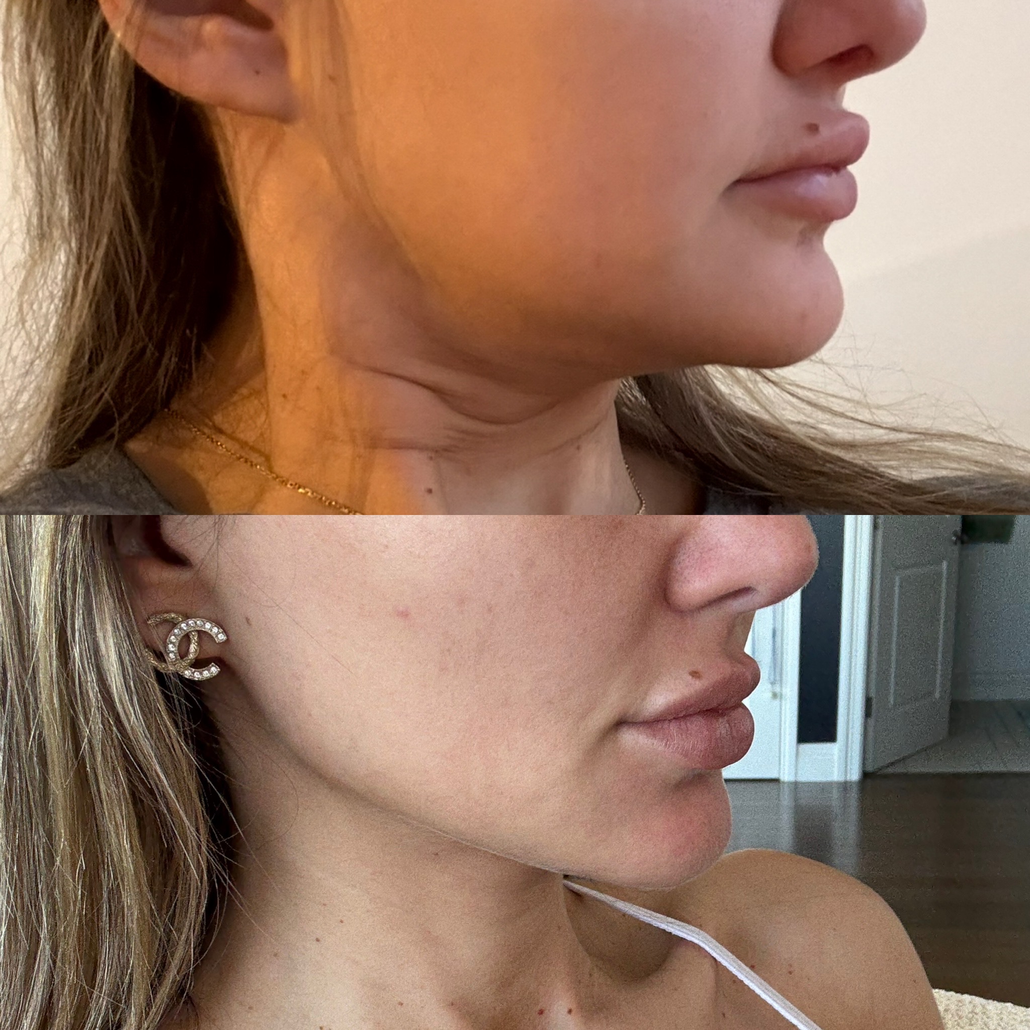 Xerf skin tightening before and after &mdash; patient 1