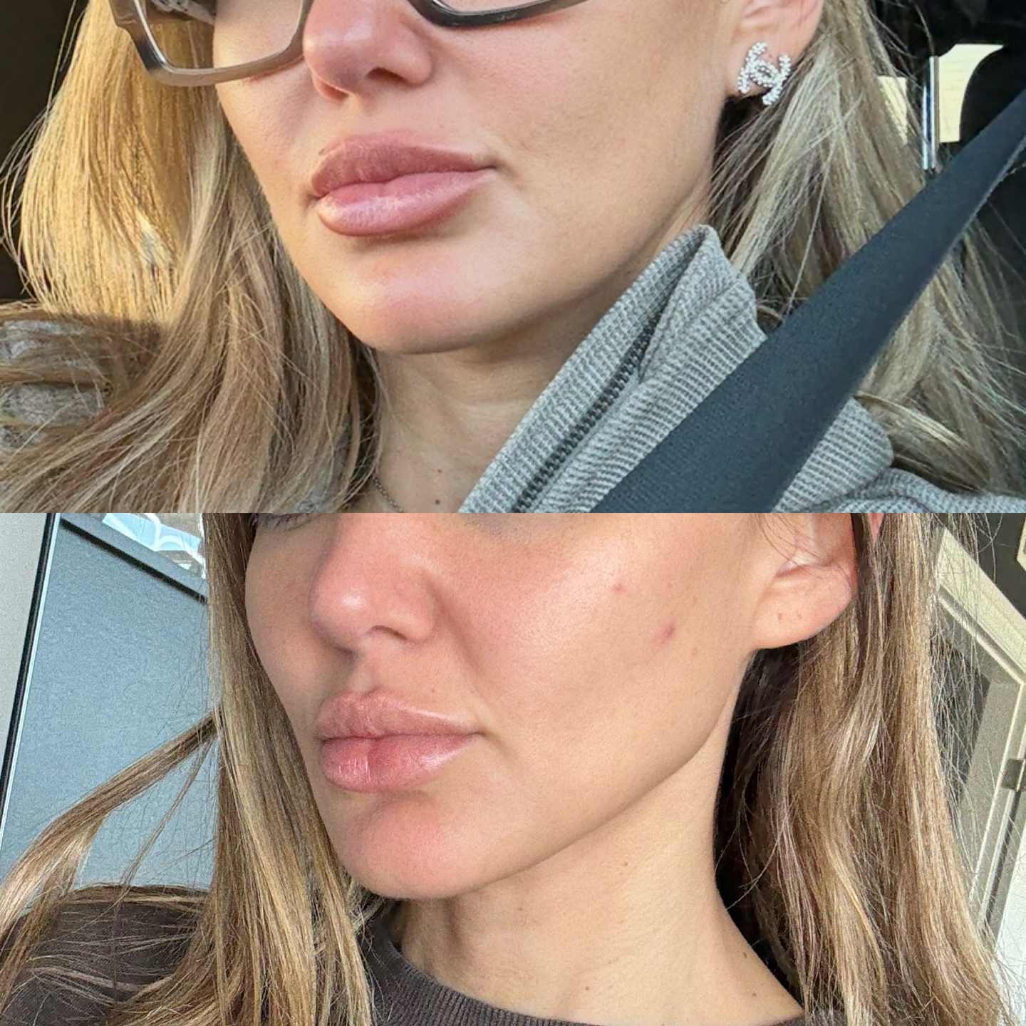 Xerf skin tightening before and after &mdash; patient 2